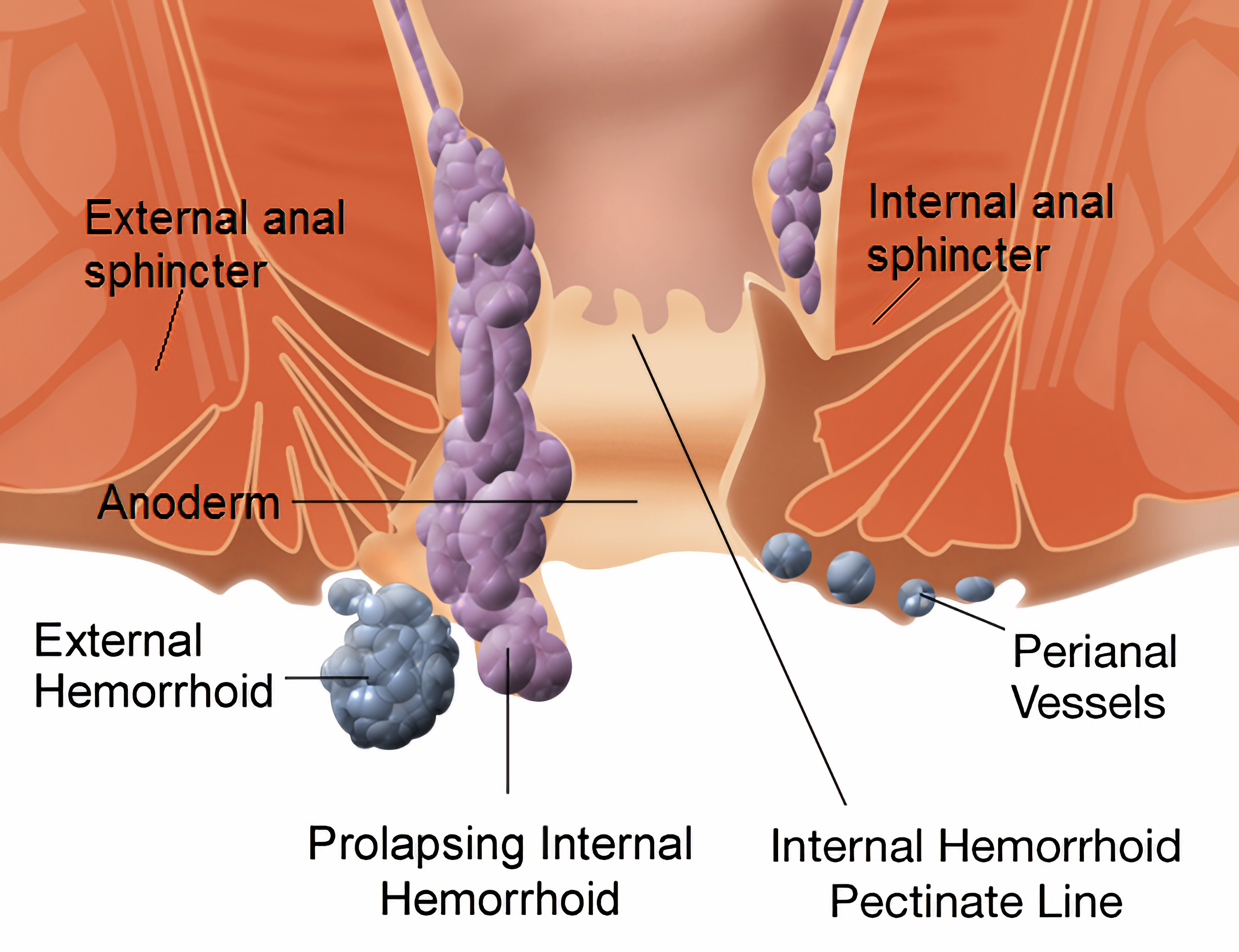 Illustration of the anal canal showing the external anal sphincter, internal anal sphincter, and hemorrhoids at different levels within the anal canal.