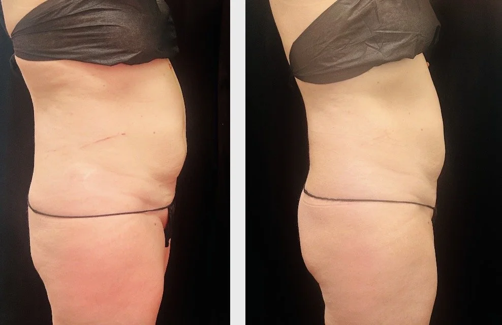 Side-by-side comparison of a person's torso before and after weight loss or body transformation, with the left showing a larger abdomen and the right showing a more toned abdomen.