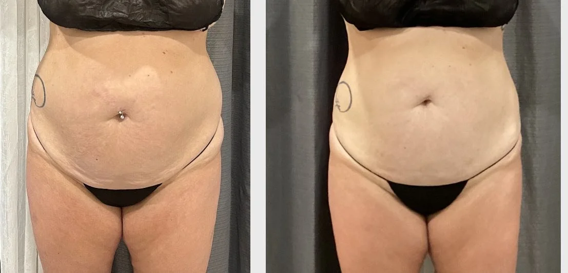 Comparison of a woman's abdomen before and after a procedure or weight loss; both images show her in black underwear with visible tattoos on her sides.
