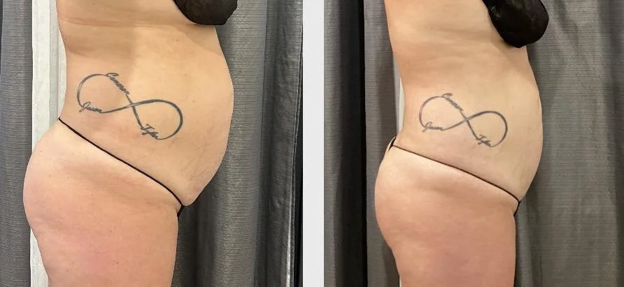 Side-by-side comparison photo showing a person's side view before and after a cosmetic procedure, highlighting a reduction in body fat around the abdomen and waist area.