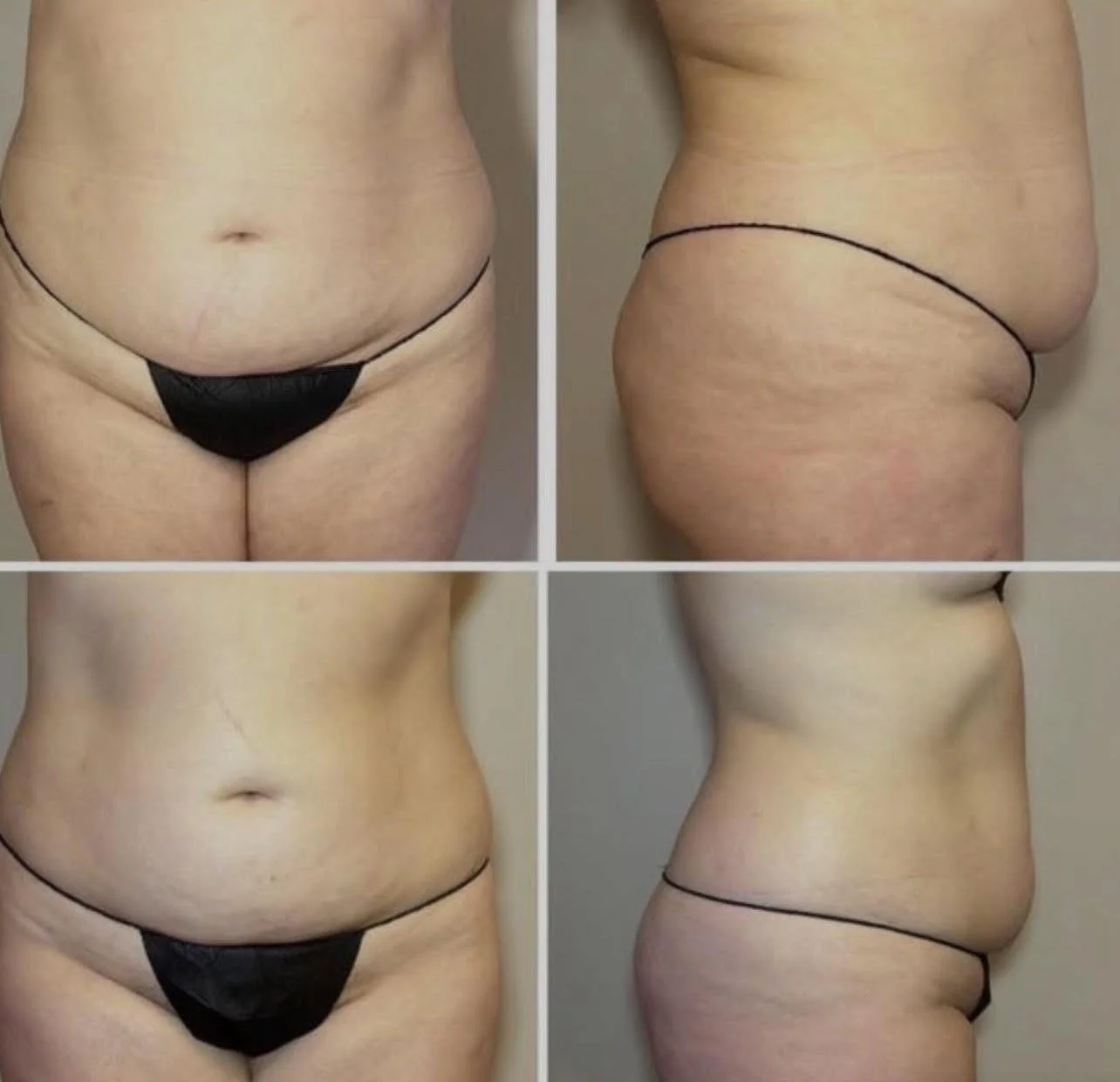 Comparison of a person's midsection before and after weight loss, showing reduced abdominal and side fat