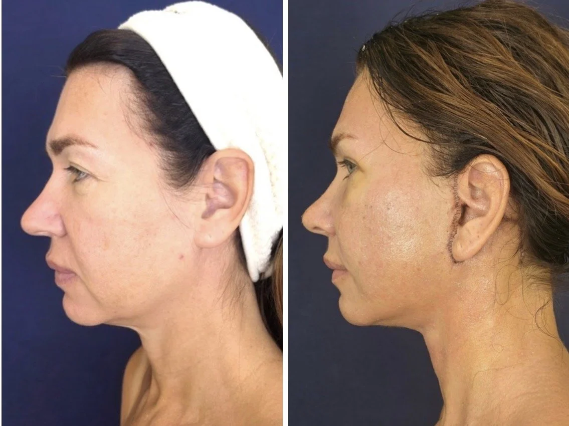 Side-by-side comparison of a woman before and after cosmetic surgery. The left image shows her with a natural nose and smooth skin, while the right image shows her with a more defined nose, changed ear shape, and repaired facial features.
