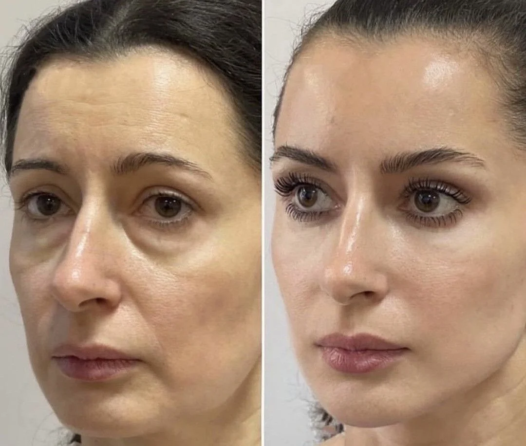 Side-by-side comparison of a woman's face before and after skin treatments, showing smoother skin and enhanced features in the after photo.