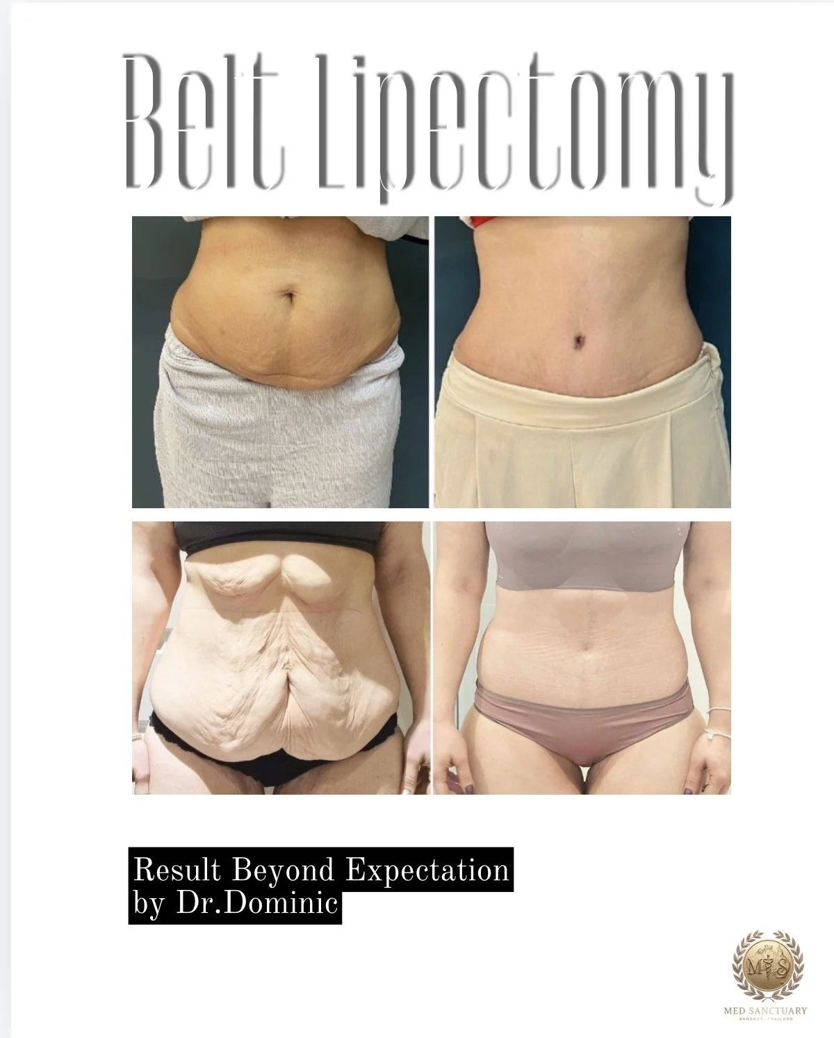 A before and after comparison of a woman's abdomen showing improvement in skin appearance and reduced excess skin following a procedure or treatment.