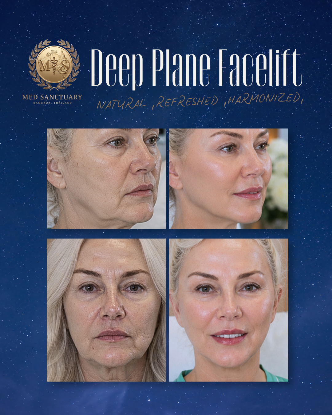 Deep Plane Facelift and Neck Lift by Dr.Rushapol - 53.png