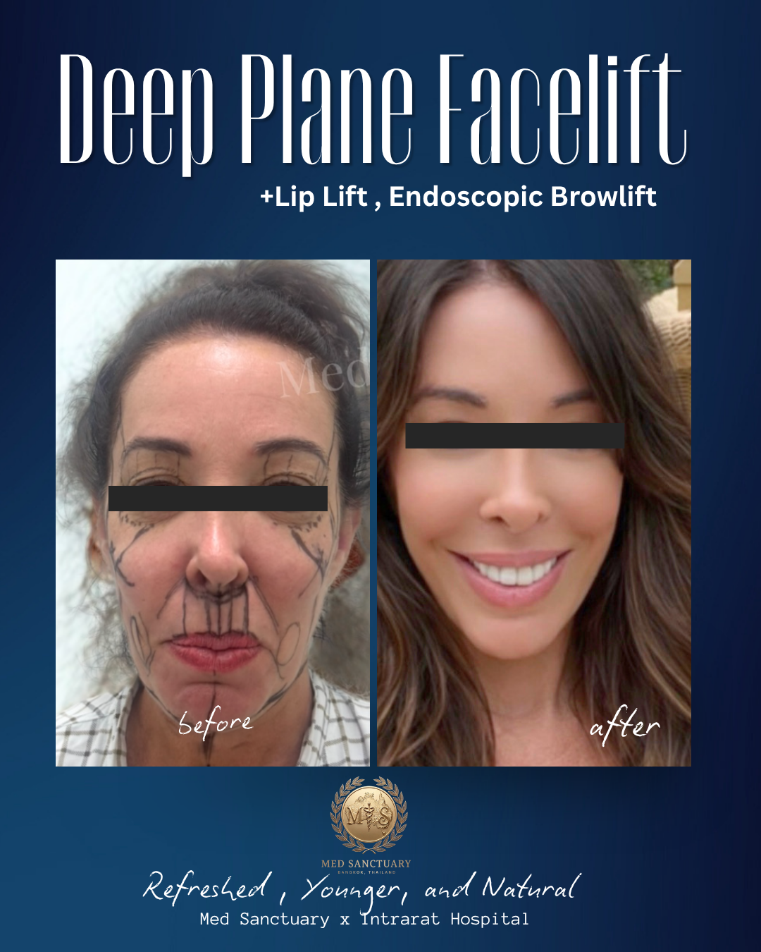Deep Plane Facelift and Neck Lift by Dr.Rushapol - 38.png