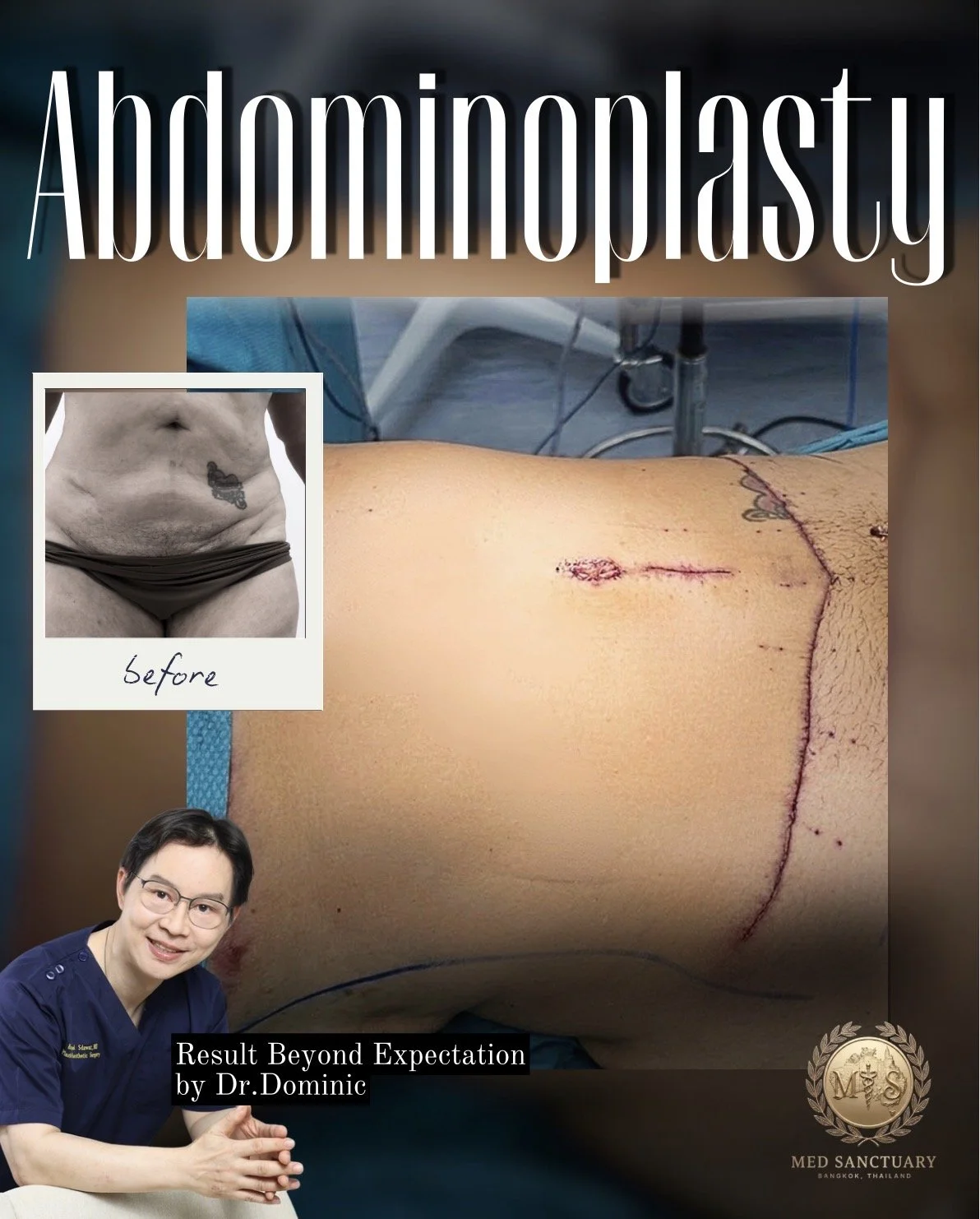 Post-surgical image of a person's abdomen showing a large scar, with an inset photo of a woman’s lower abdomen before surgery, featuring a butterfly tattoo. The image promotes Dr. Dominic's abdominaloplasty procedure at Med Sanctuary in Bangkok, Thai