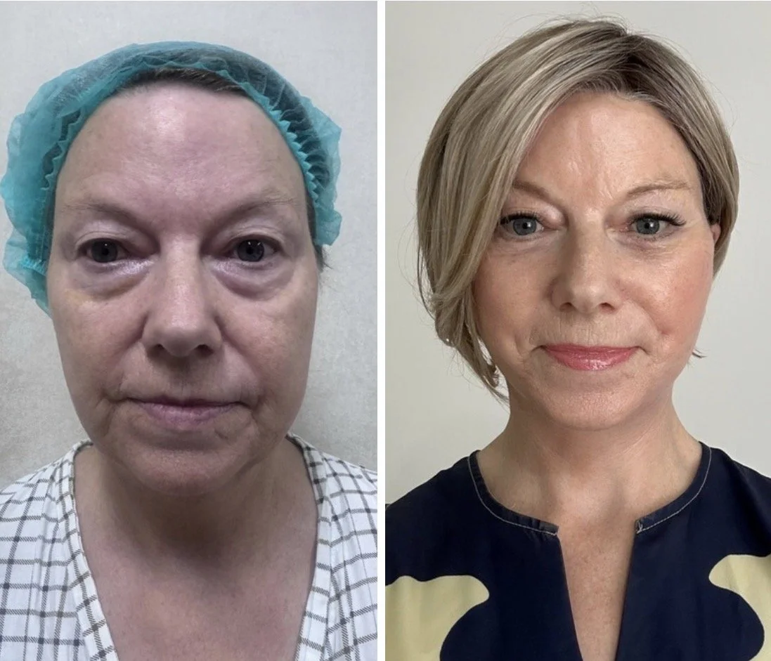 Side-by-side comparison of a woman before and after cosmetic or skincare treatment. The before photo shows her with under-eye puffiness and skin imperfections, wearing a hospital gown and hairnet. The after photo shows her with smoother skin, fewer u