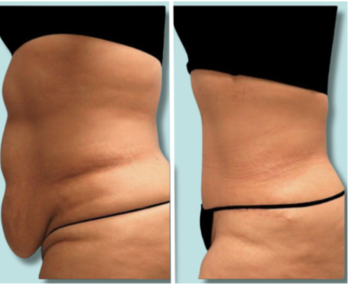 Side-by-side comparison of a person's abdomen showing before and after weight loss or body contouring.