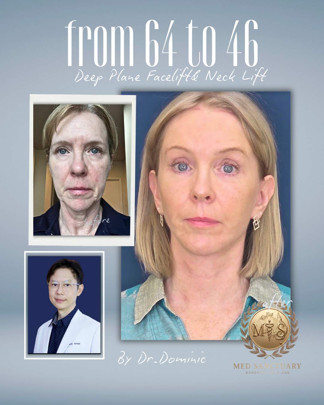 A before-and-after photo showing a woman who has undergone a deep plane facelift for the neck, with the after image revealing a more youthful appearance. The image also includes a doctor in a white coat, and texts indicating the procedure from age 64