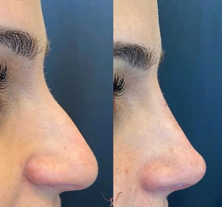 Close-up side view of a person's nose before and after rhinoplasty surgery, showing the nose's improved shape.