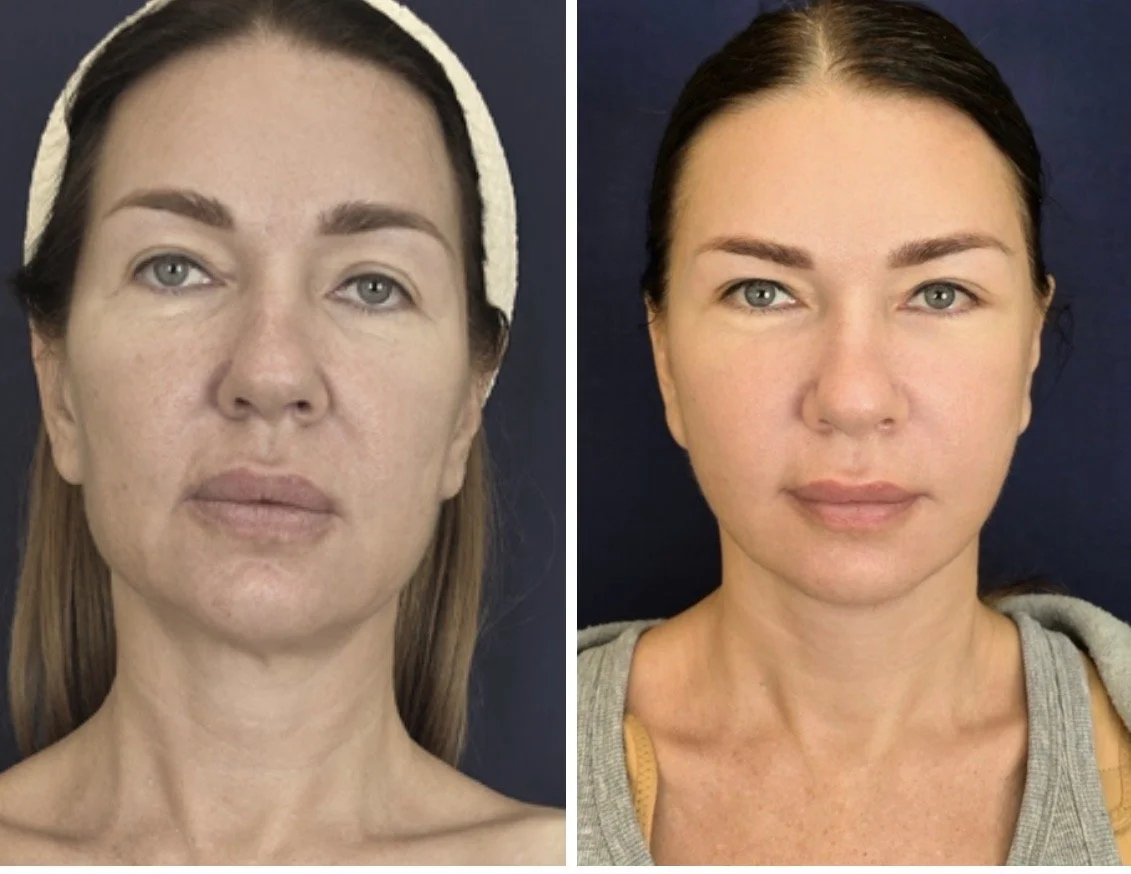 Side-by-side comparison of a woman's face before and after skincare or cosmetic treatment, showing improved skin clarity and texture.