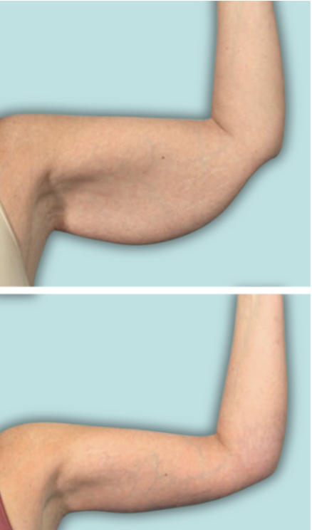 Comparison of upper arms showing loose skin or sagging in the top image and tighter skin in the bottom image.