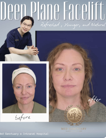 A promotional magazine cover for deep plane facelift procedure showing a woman before and after treatment. The 'before' image shows a woman with a headband and tired appearance. The 'after' image shows the same woman with a more youthful, refreshed l
