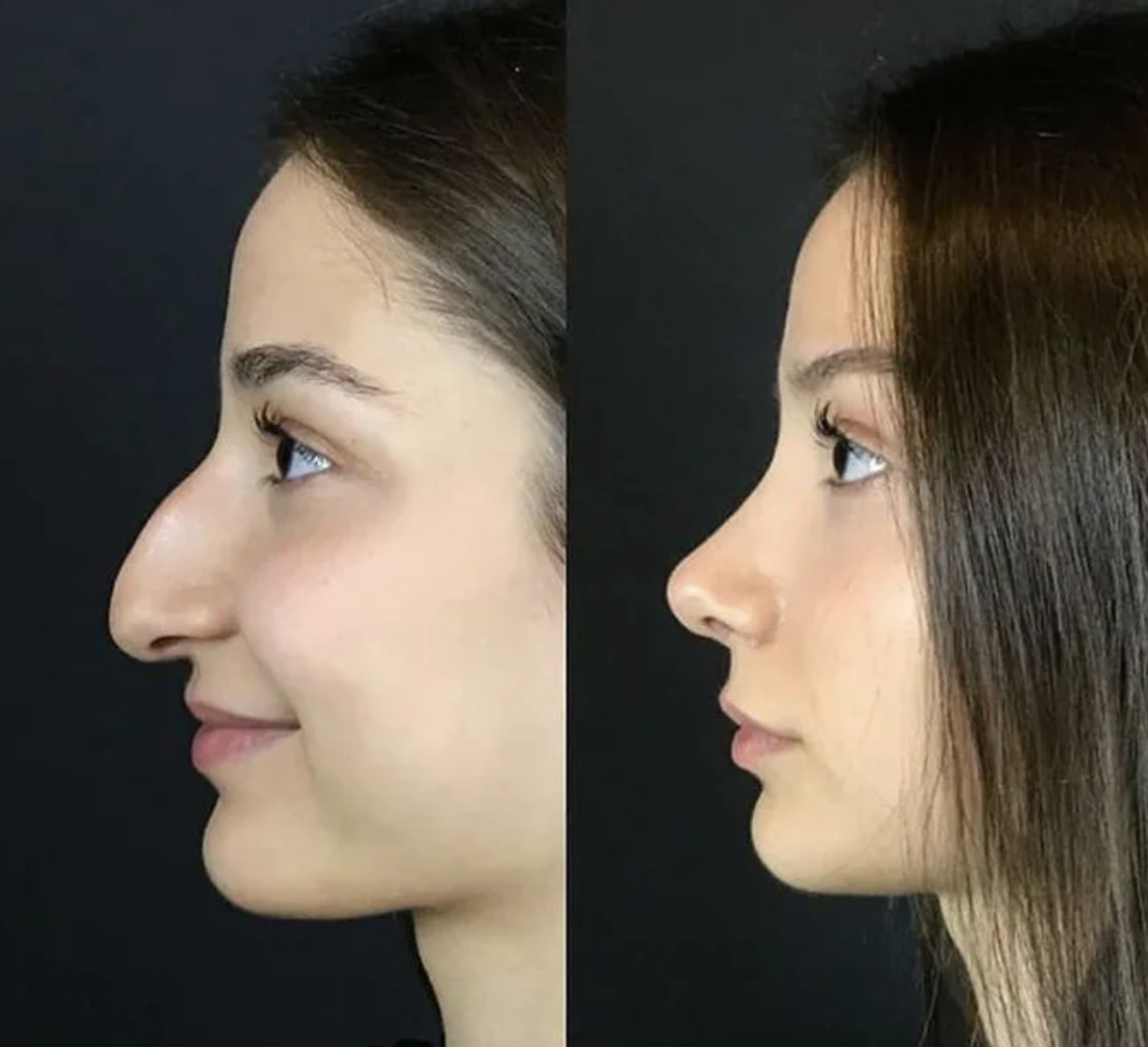 Side-by-side comparison of a woman's face before and after rhinoplasty, showing an improved nose profile.