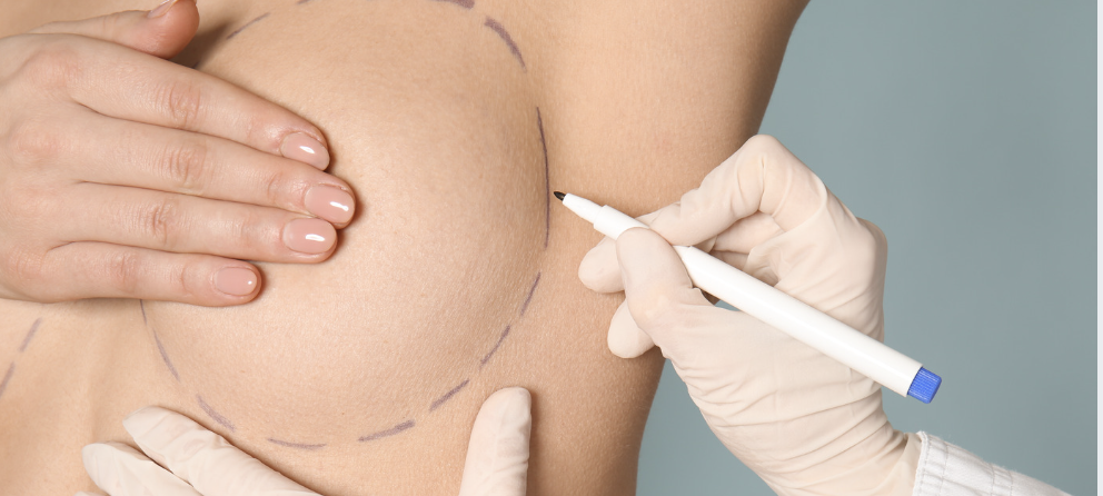 A person with markings on their chest, possibly preparing for a surgical procedure, with a healthcare professional drawing on their skin with a marker.