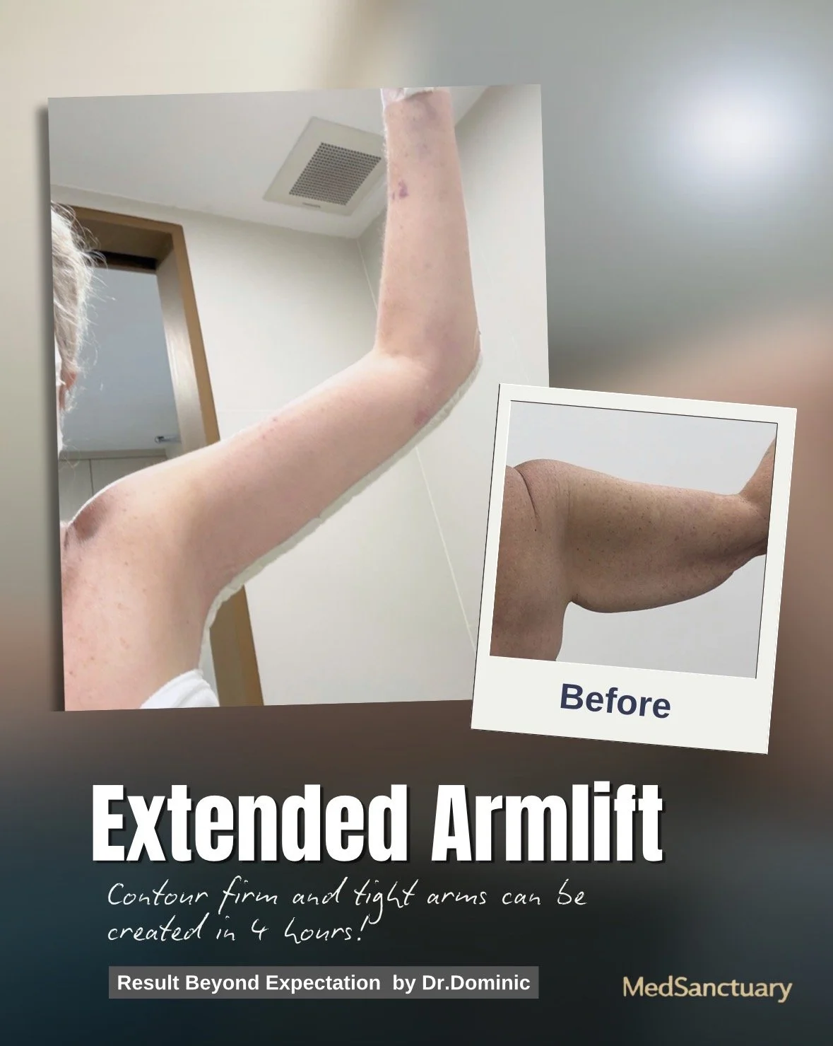 A before and after comparison of a person's arm, showing an increase in muscle tone and appearance of toned arms after a treatment called 'Extended Armlift.' The image includes a smaller inset labeled 'Before' depicting the arm prior to the procedure