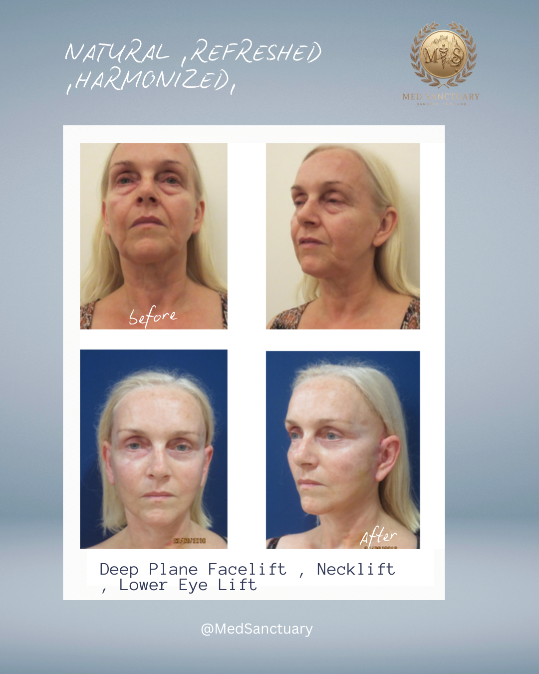 Before and after photos of a woman showing facial improvements from deep plane facelift, neck lift, and lower eye lift, with marked changes in skin tightness and facial contours.