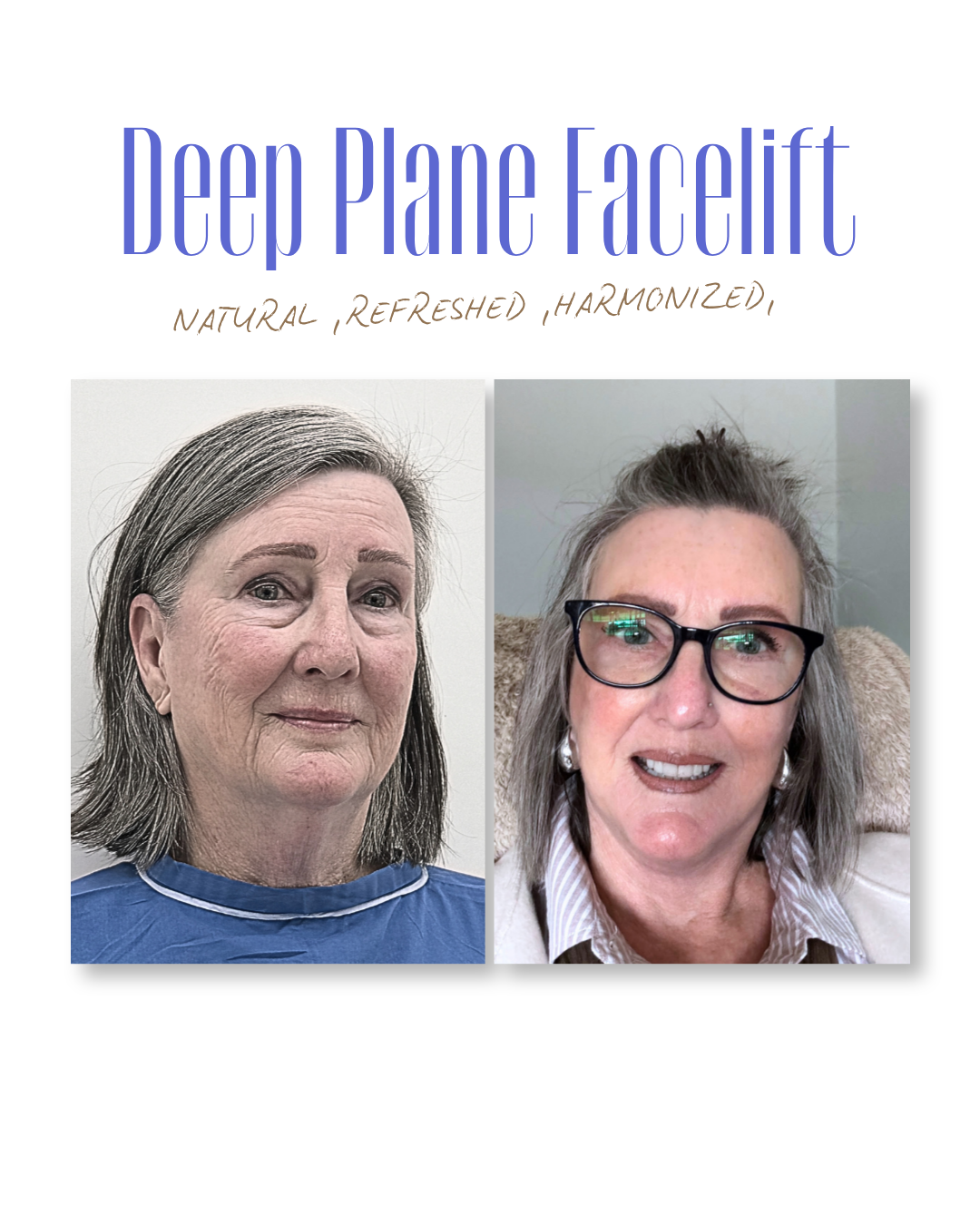 Deep Plane Facelift and Neck Lift by Dr.Rushapol - 50.png