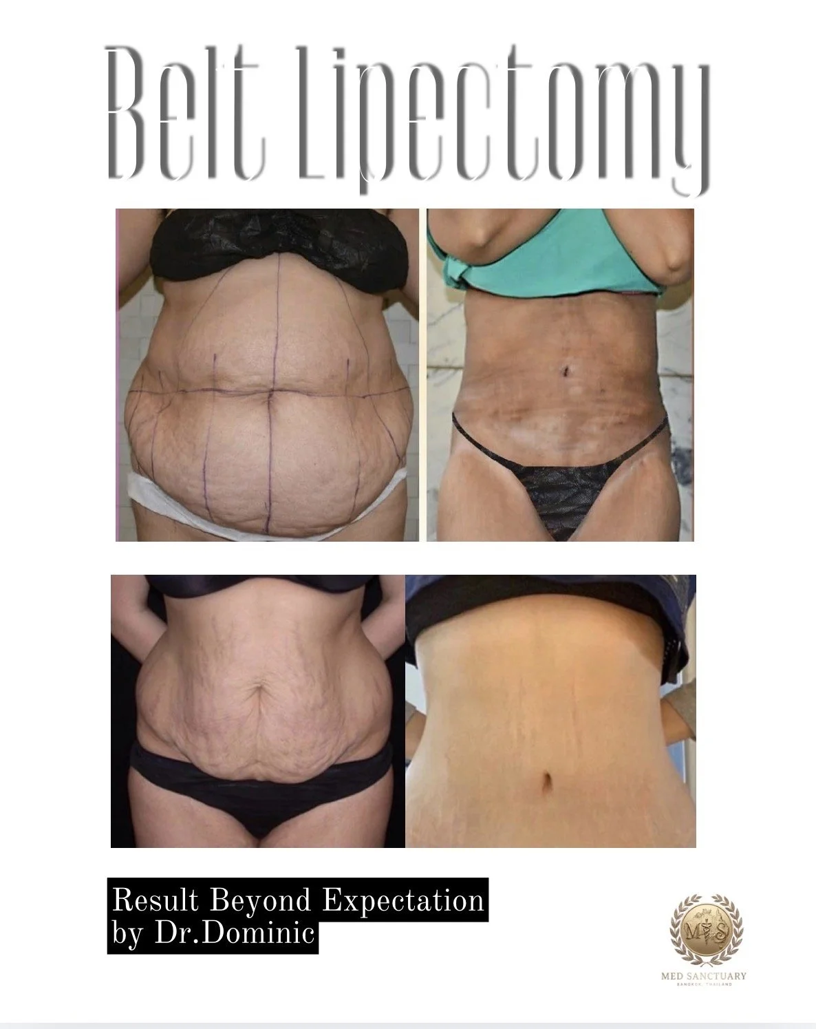 Before and after images depicting a significant transformation of a person's abdominal area following a belt lipectomy procedure.