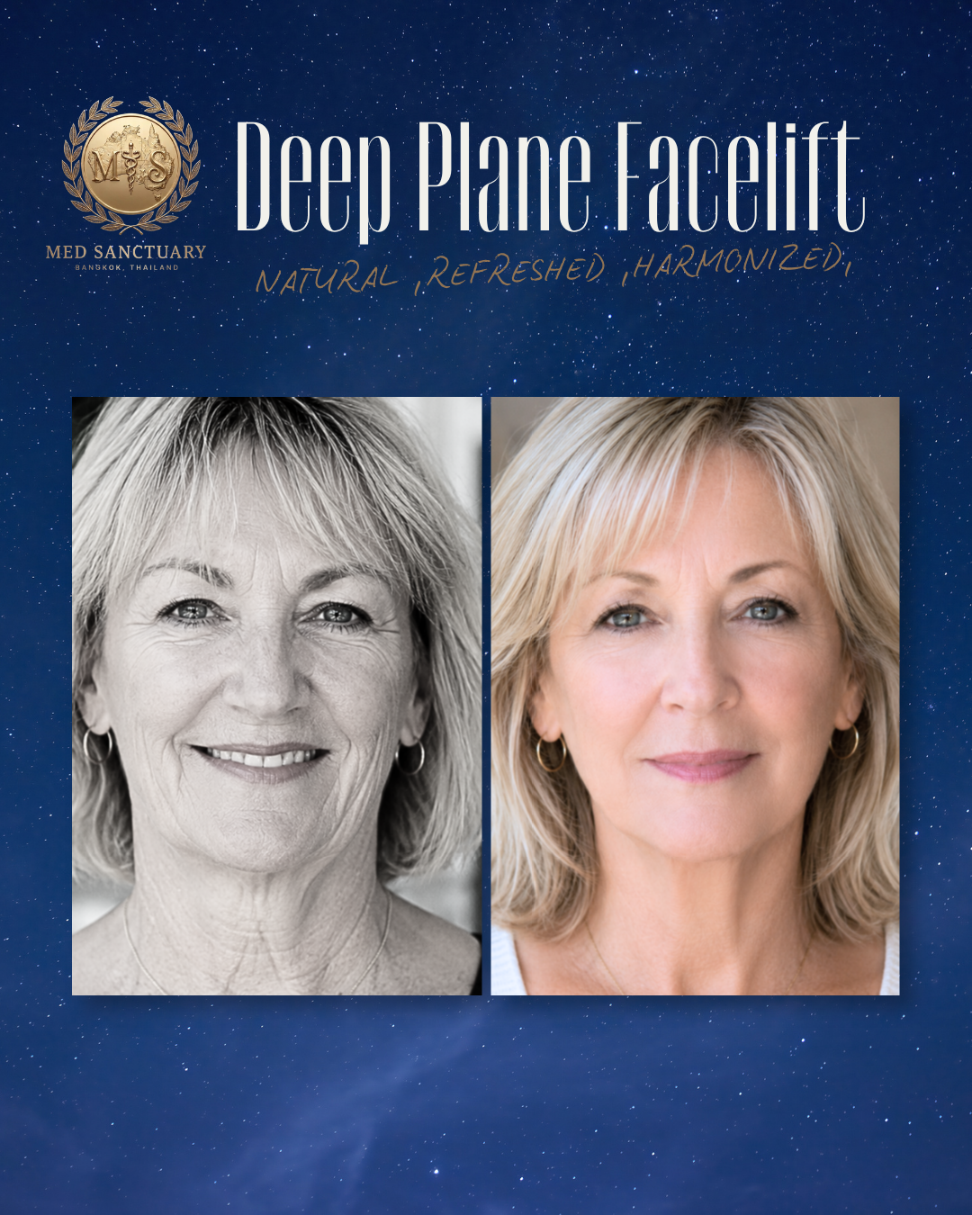 Deep Plane Facelift and Neck Lift by Dr.Rushapol - 48.png