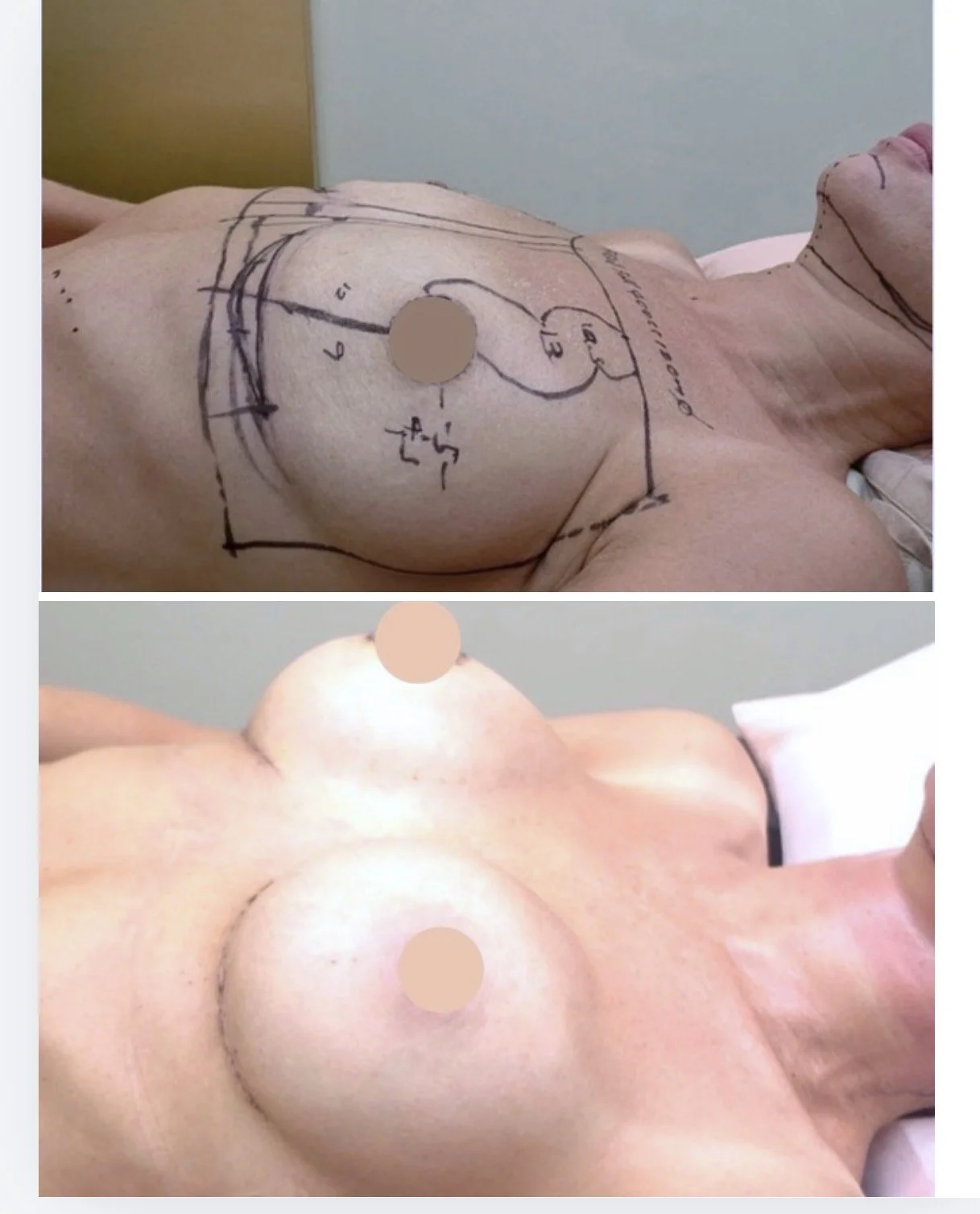 Before and after images of a breast augmentation cosmetic surgery, showing marked surgical plan in the first image and the results after implant placement in the second image.