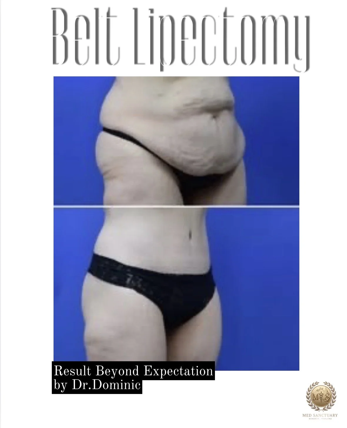Comparison of a person's torso before and after weight loss, showing a significant reduction in abdominal fat with text 'Belt Lipotomy' at the top and 'Result Beyond Expectation by Dr. Dominic' at the bottom.