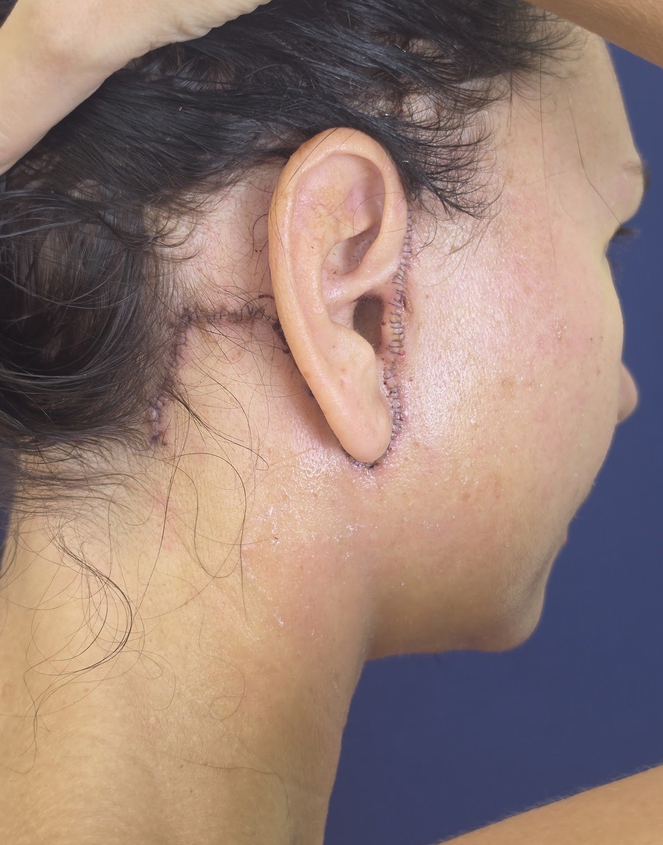 Close-up of a person's head showing a fresh surgical scar behind the ear, with visible stitches, and the person's hand resting on their head.