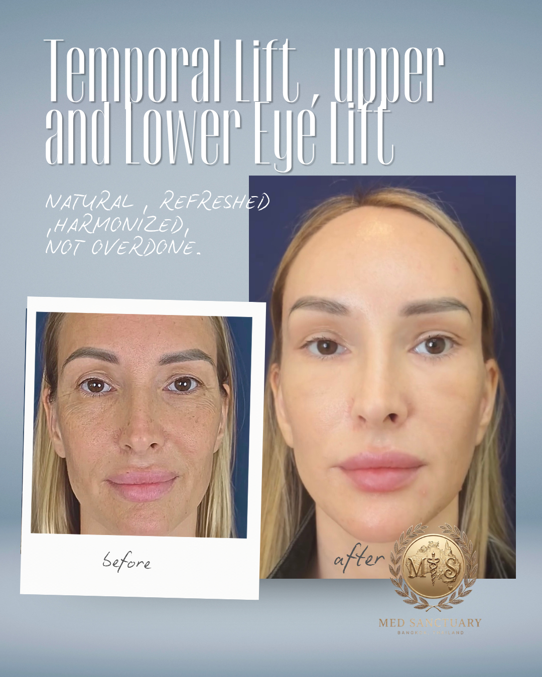 Side-by-side comparison of a woman's face before and after upper and lower eyelift, showing smoother skin and lifted appearance, with text mentioning natural, refreshed, harmonized, not overdone.