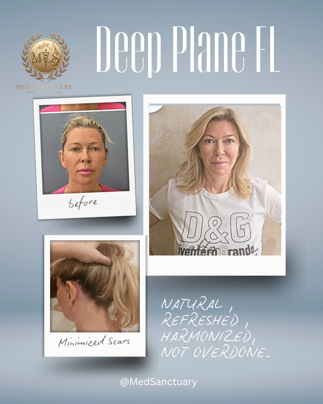 A collage showing before and after photos of a woman with minimal scars and improved skin. The image includes the Med Sanctuary logo, text 'Deep Plane FL', and handwritten notes describing the results as natural, refreshed, harmonized, and not overdo