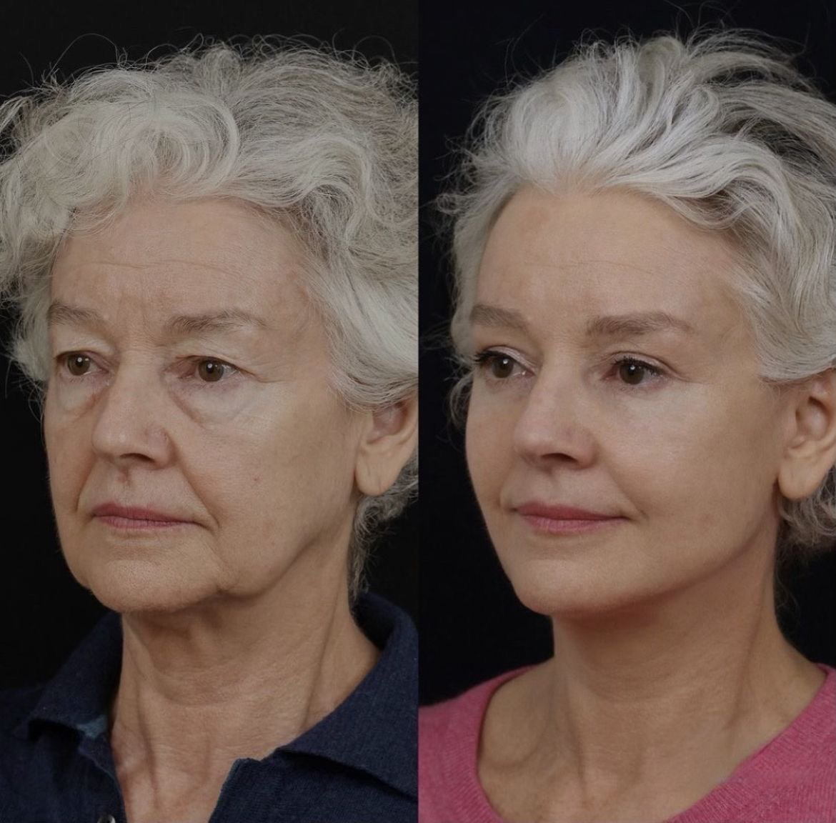 Side-by-side comparison of an elderly woman before and after cosmetic treatment, showing smoother skin and a more youthful appearance on the right.