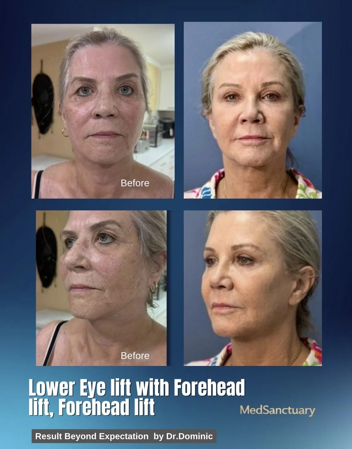 Before and after photos of a woman showing the results of lower eye and forehead lift procedures. The top row shows her face before the treatments with sagging skin, and the bottom row shows her improved appearance with tighter skin and a more youthf