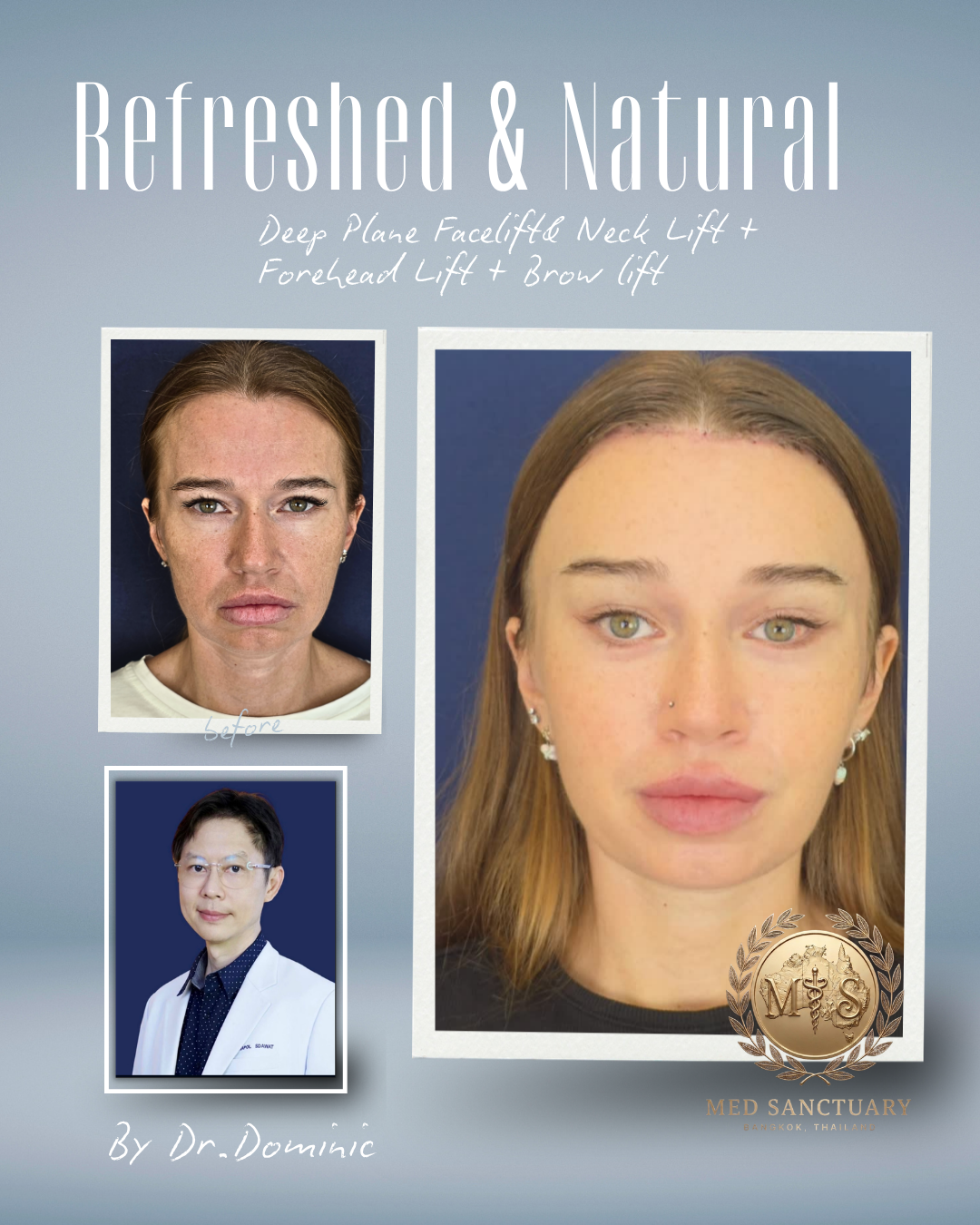 Before and after photos of a woman showing facial improvements from a deep plane facelift, neck lift, forehead lift, and brow lift performed by Dr. Dominic at Med Sanctuary in Bangkok, Thailand.
