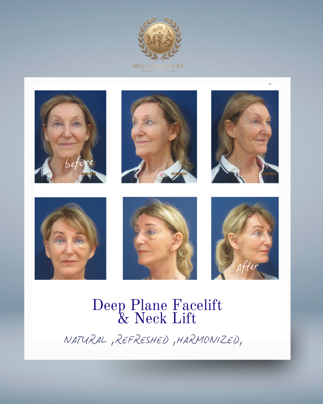 Before and after photos of a woman showing facial and neck changes from a deep plane facelift and neck lift, with the Med Sanctuary logo at the top and text describing the cosmetic procedure at the bottom.