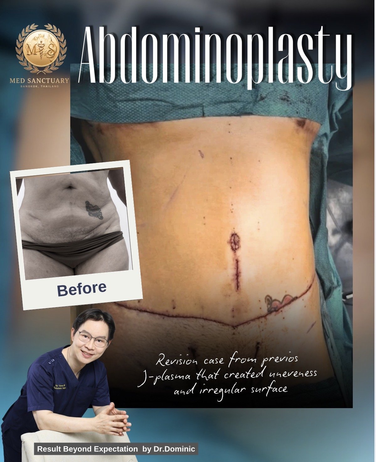 Postoperative abdomen showing surgical scars after abdominoplasty, with an inset photo of the preoperative abdomen displaying excess skin and a tattoo. The image includes a portrait of Dr. Dominic, a medical professional, and text indicating a succes