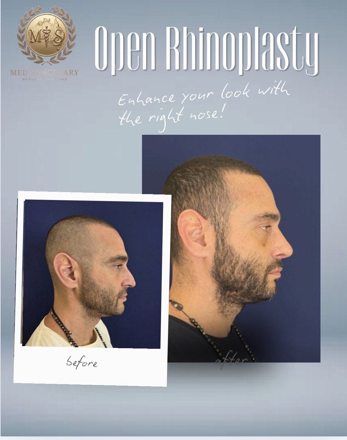 Before and after photos showing a man's profile, demonstrating rhinoplasty results. The 'before' photo shows a man with a more prominent nose, and the 'after' photo shows a more refined nose. Text indicates the photos are related to open rhinoplasty.