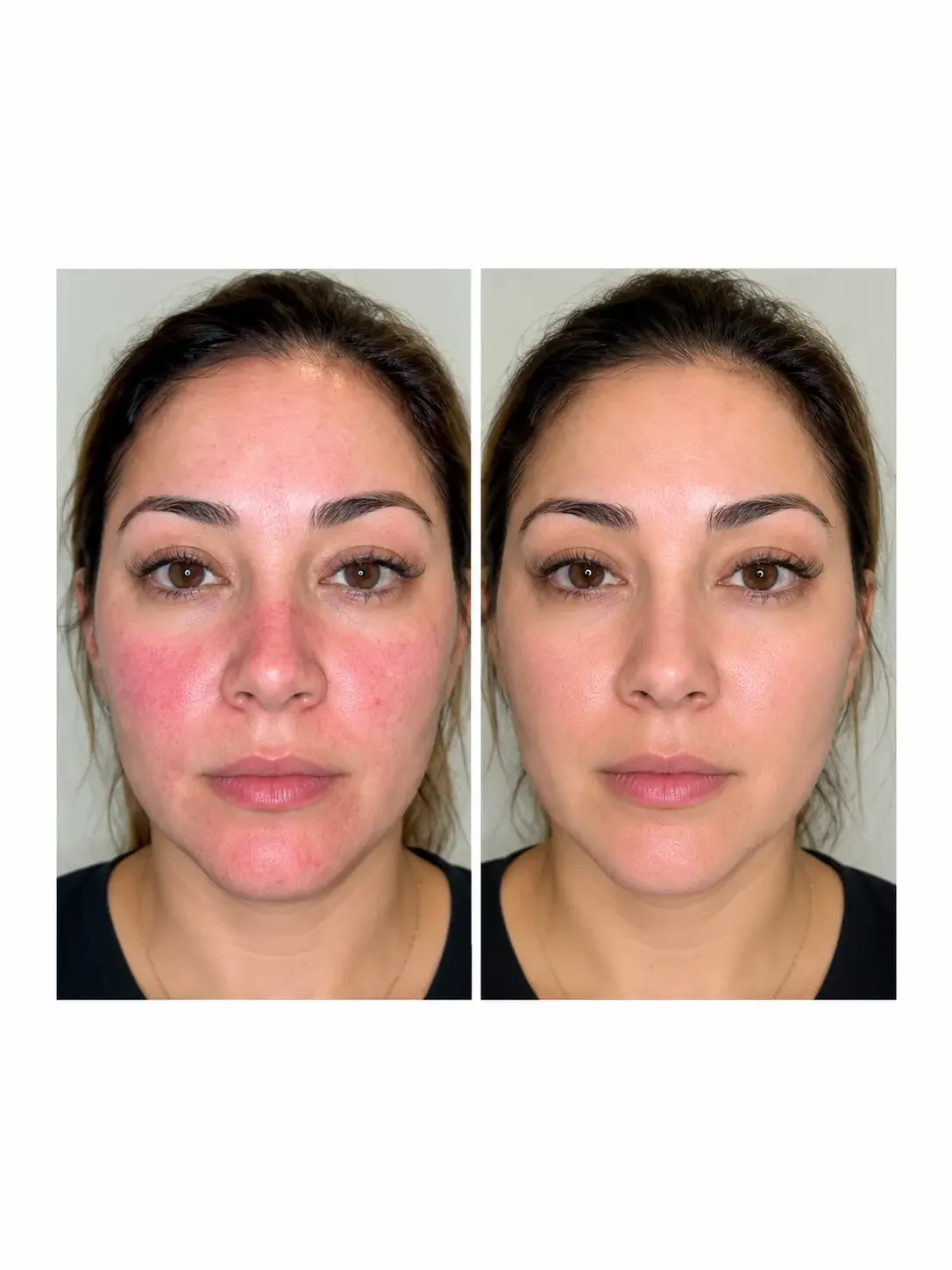 SKIN MATRIX No. 7™ Before and After Facial Redness Comparison Showing Rosacea-Prone Skin with a Calmer, More Even-Looking Complexion