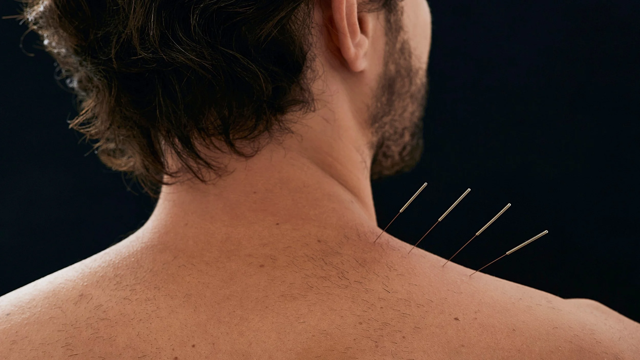 Person receiving acupuncture treatment on the neck and upper shoulder area, with acupuncture needles inserted.