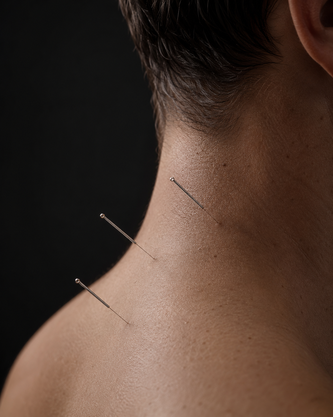 Close-up of a person's neck with three acupuncture needles inserted into the skin.
