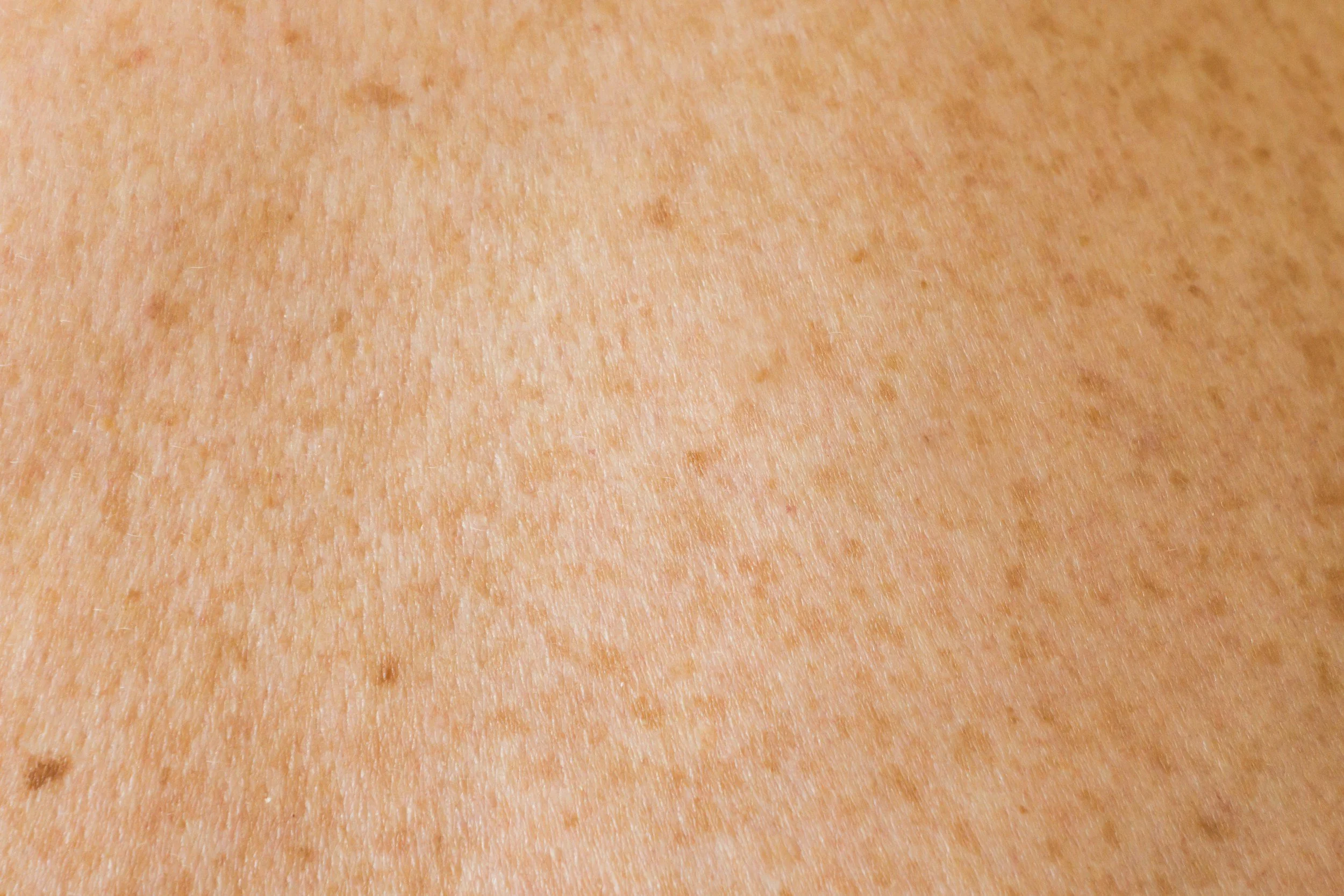 Close-up of healthy human skin with visible pores and freckles.