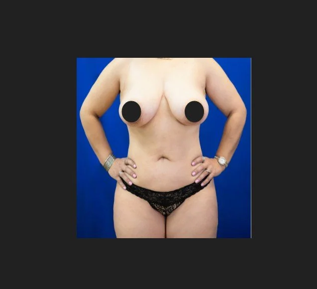 Liposuction Fat Transfer and BBL Consultation