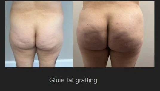 glute fat graft.jpg