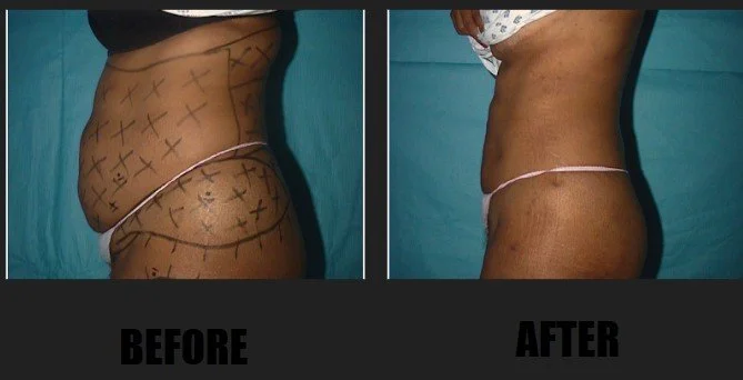 lipo5.jpg