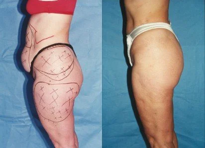 Lipo at Shadow Medical