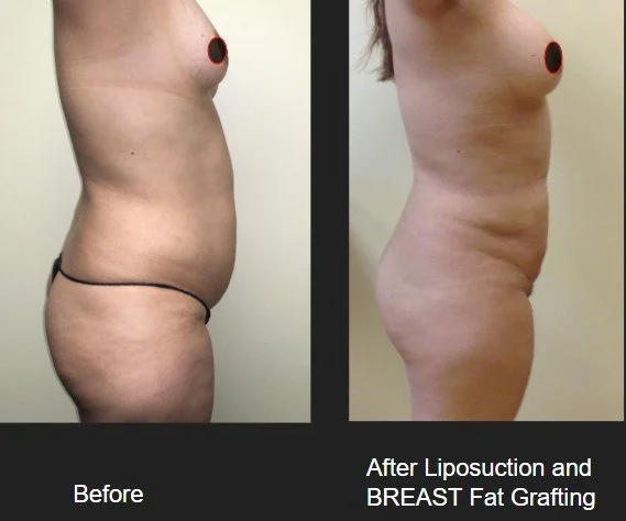 breastgraft lipo.jpg
