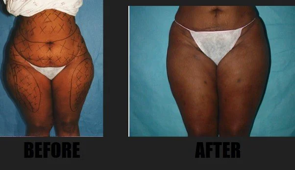 lipo6.jpg