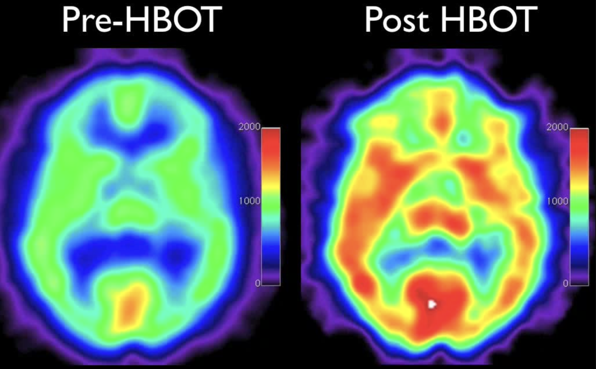 Thermal brain scans comparing pre- and post-HBOT, with colorful heat map patterns showing increased activity after HBOT.