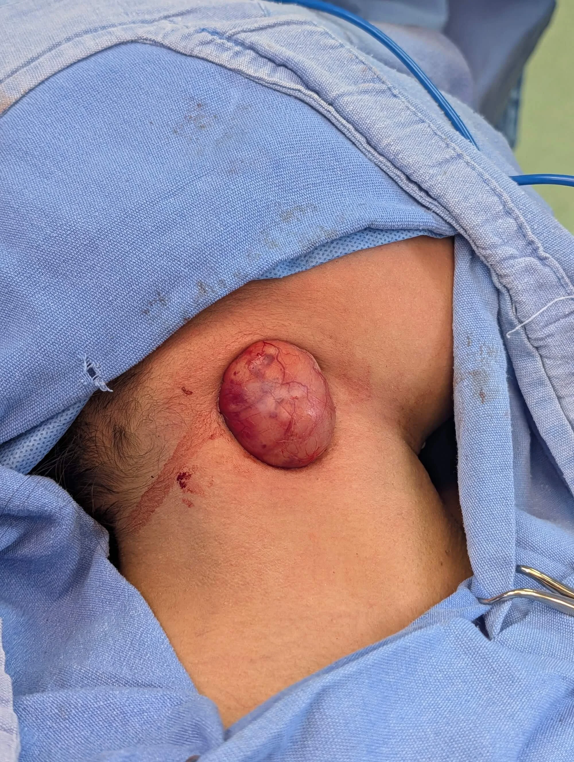 Imagen que muestra un quiste braqueal en una persona que viste ropa quirúrgica azul.
