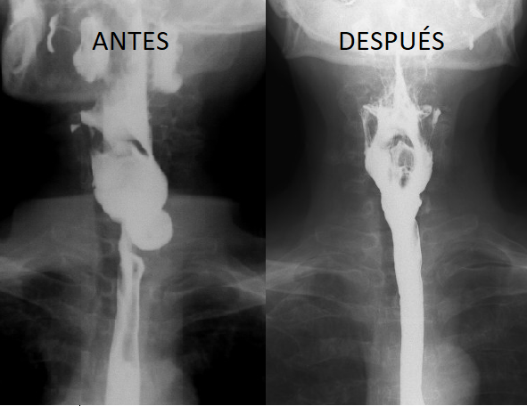 Radiografía del antes y después de una cirugía por Divertículo de Zenker