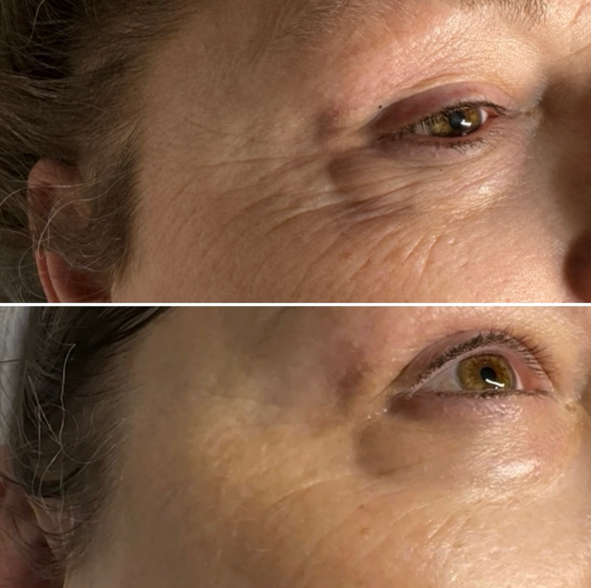 Close-up comparison of a person's eye area, showing wrinkles and skin texture in the top image, and smoother skin with fewer wrinkles in the bottom image.